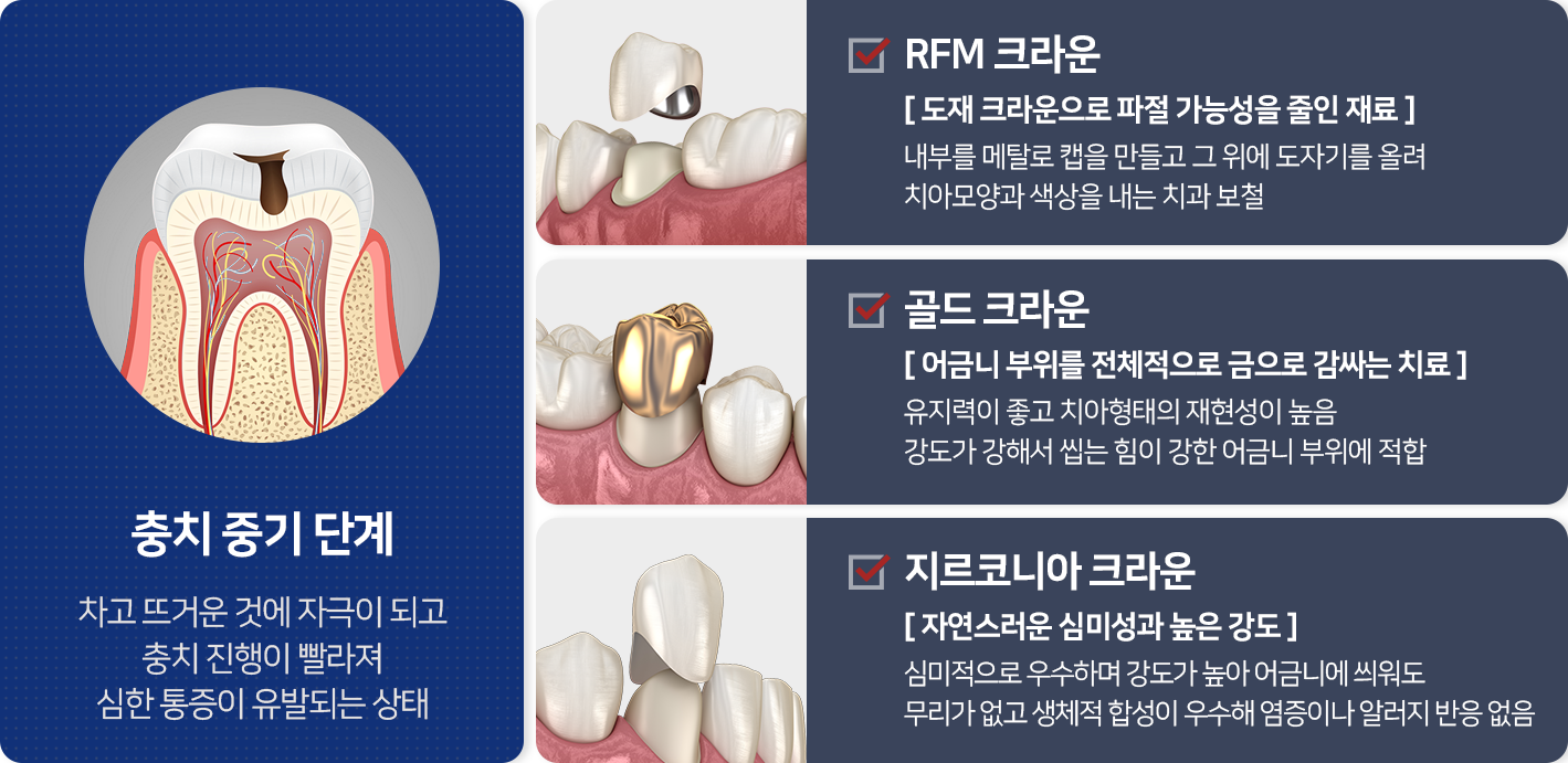충치-중기-단계-차고-뜨거운-것에-자극이-되고-충치-진행이-빨라져-심한-통증이-유발되는-상태-RFM-크라운-도재-크라운으로-파절-가능성을-줄인-재료-내부를-메탈로-캡을-만들고-그-위에-도자기를-올려-치아-모양과-색상을-내는-보철-골드-크라운-어금니-부위를-전체적으로-금으로-감싸는-치료-유지력이-좋고-치아-형태의-재현성이-높음-강도가-강해서-씹는-힘이-강한-어금니-부위에-적합-지르코니아-크라운-자연스러운-심미성과-높은-강도-심미적으로-우수하며-강도가-높아-어금니에-씌워도-무리가-없고-생체적-합성이-우수해-염증이나-알러지-반응-없음