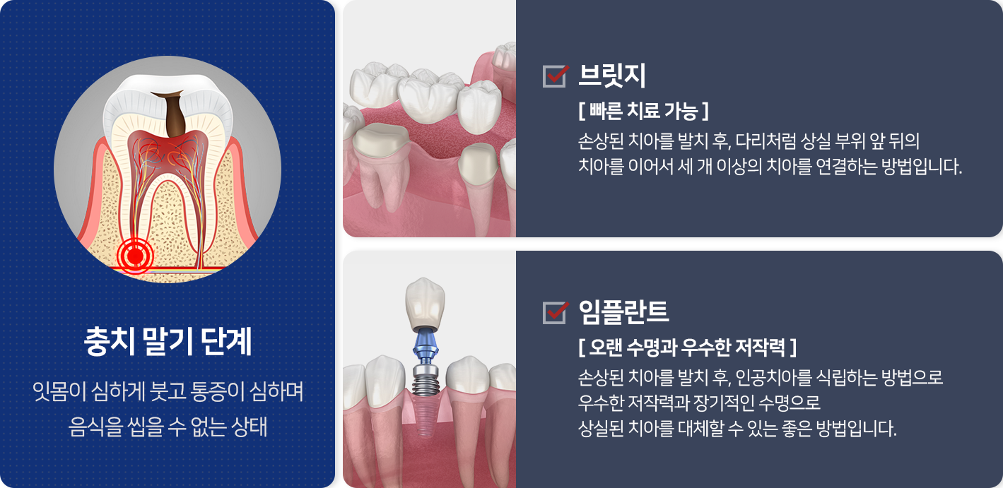 충치-말기-단계-잇몸이-심하게-붓고-통증이-심하며-음식을-씹을-수-없는-상태-브릿지-빠른-치료-가능-손상된-치아를-발치-후-다리처럼-상실-부위-앞뒤의-치아를-이어서-세-개-이상의-치아를-연결하는-방법입니다-임플란트-오랜-수명과-우수한-저작력-손상된-치아를-발치-후-인공치아를-식립하는-방법으로-우수한-저작력과-장기적인-수명으로-상실된-치아를-대체할-수-있는-좋은-방법입니다