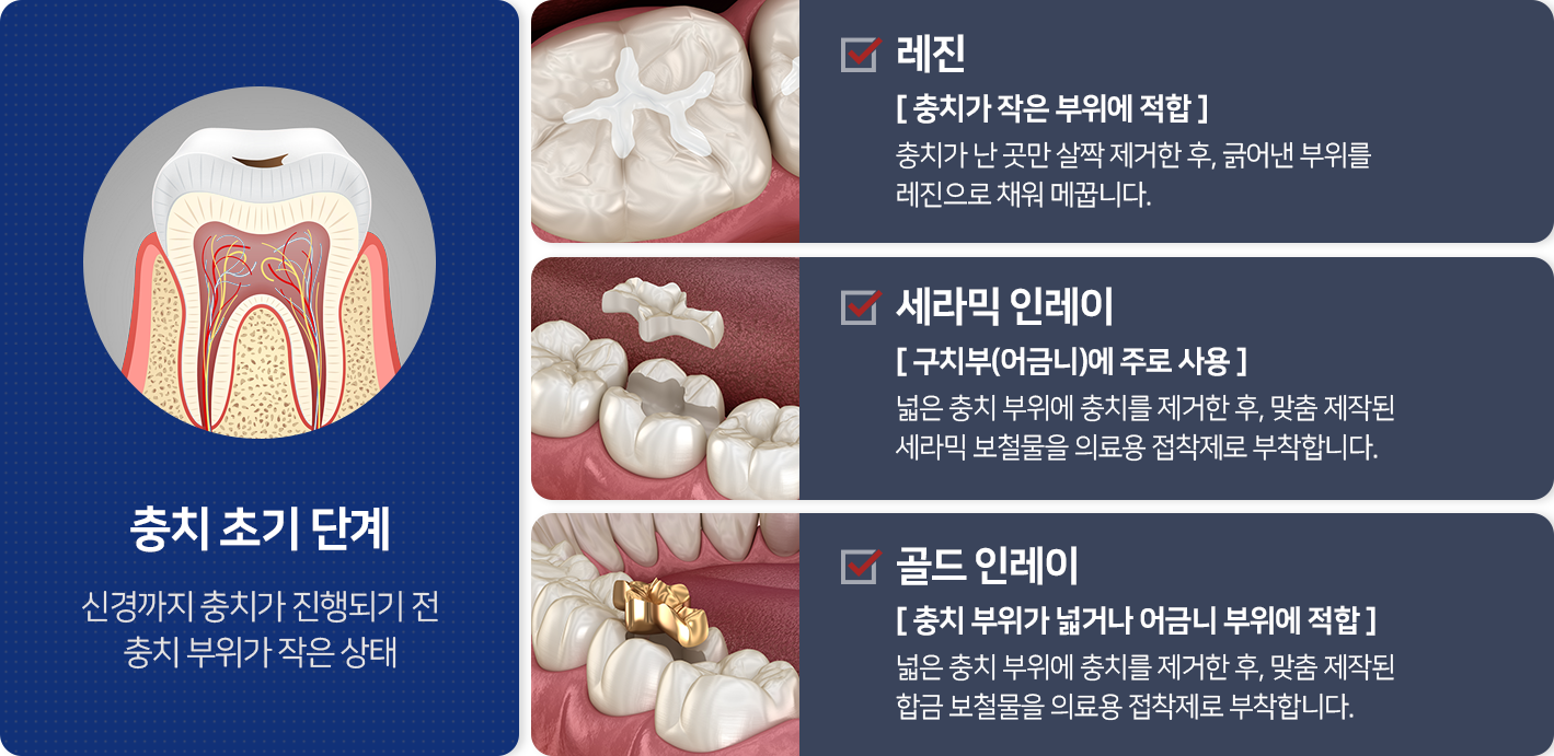 충치-초기-단계-신경까지-충치가-진행되기-전-충치-부위가-작은-상태-레진-충치가-작은-부위에-적합-충치가-난-곳만-살짝-제거한-후-긁어낸-부위를-레진으로-채워-메꿉니다-세라믹-인레이-구치부_어금니에-주로-사용-넓은-충치-부위에-충치를-제거한-후-맞춤-제작된-세라믹-보철물을-의료용-접착제로-부착합니다-골드-인레이-충치-부위가-넓거나-어금니-부위에-적합-넓은-충치-부위에-충치를-제거한-후-맞춤-제작된-합금-보철물을-의료용-접착제로-부착합니다