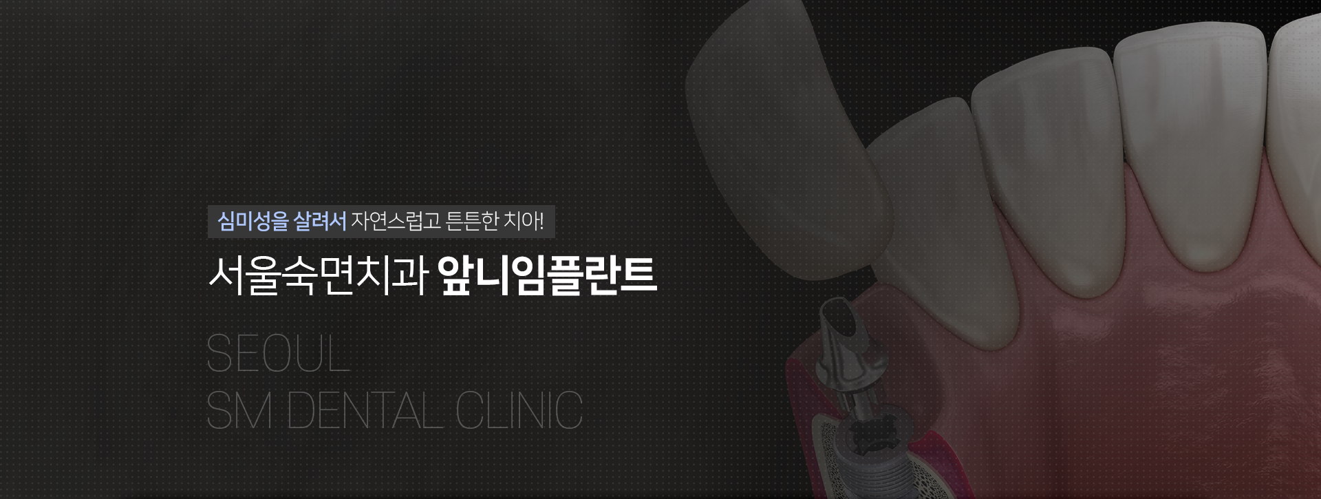 심미성을-살려서-자연스럽고-튼튼한-치아-서울숙면치과-앞니-임플란트