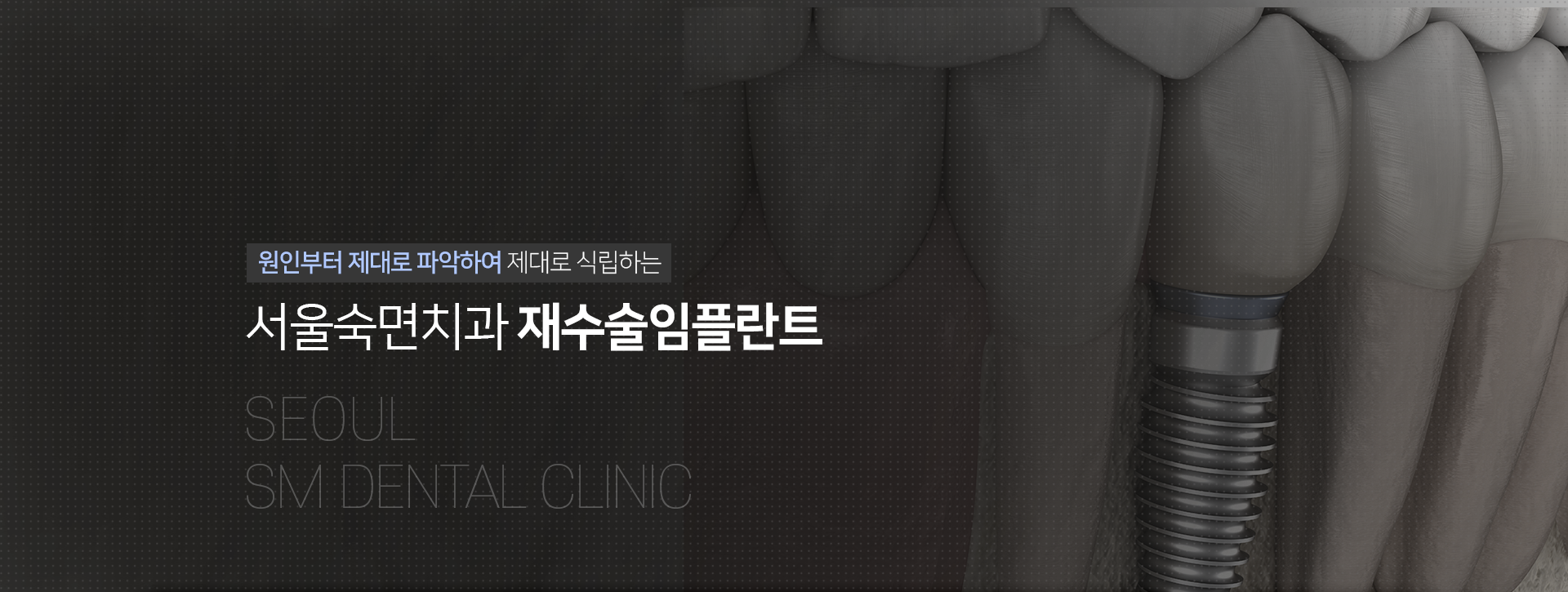 원인부터-제대로-파악하여-제대로-식립하는-서울숙면치과-재수술-임플란트