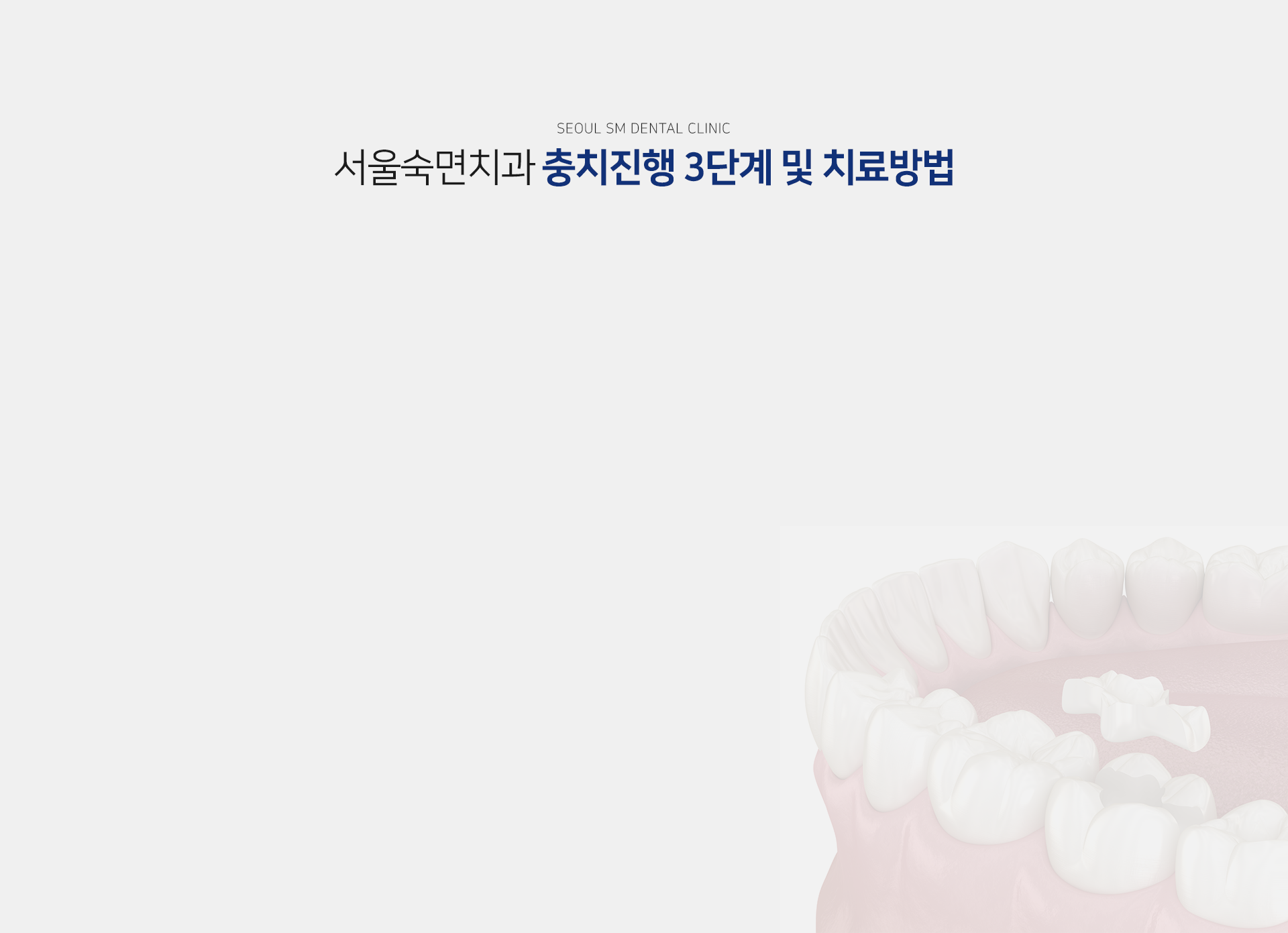 충치진행-3단계-및-치료-방법